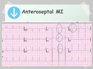 Anteroseptal MI
 