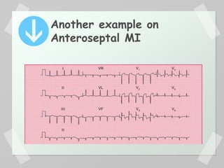 Another example on
Anteroseptal MI
 