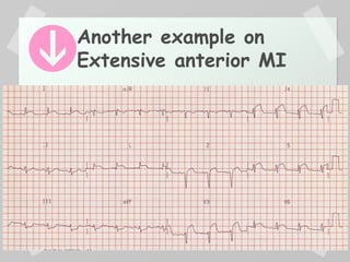 Another example on
Extensive anterior MI
 