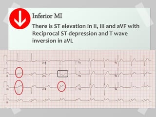 Inferior MI
There is ST elevation in II, III and aVF with
Reciprocal ST depression and T wave
inversion in aVL
 