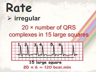 Rate
 irregular
20 × number of QRS
complexes in 15 large squares
 