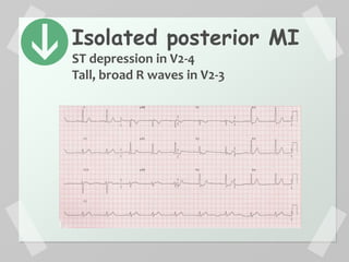 Isolated posterior MI
ST depression in V2-4
Tall, broad R waves in V2-3
 