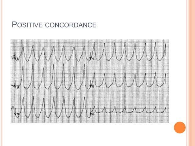 wide complex tachycardia | PPTX | Heart and Cardiovascular Diseases ...