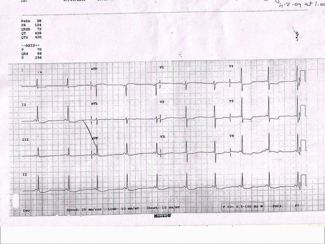 ECG Wolff Parkinson White Syndrome PPT