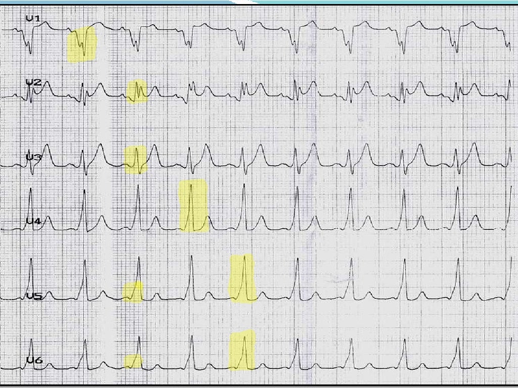 ECG WolffParkinsonWhite syndrome ECG WolffParkinsonWhite syndrome