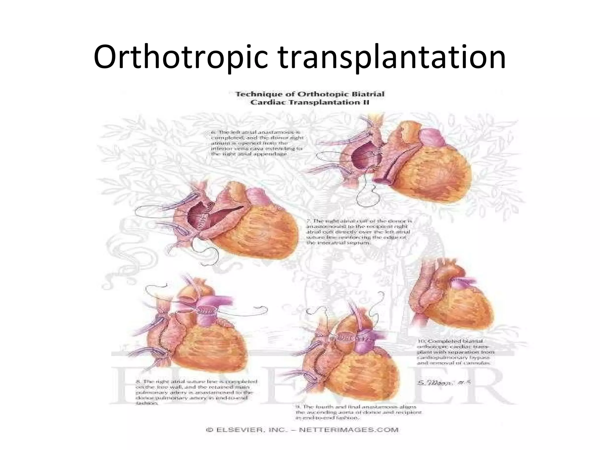 Orthotropic transplantation