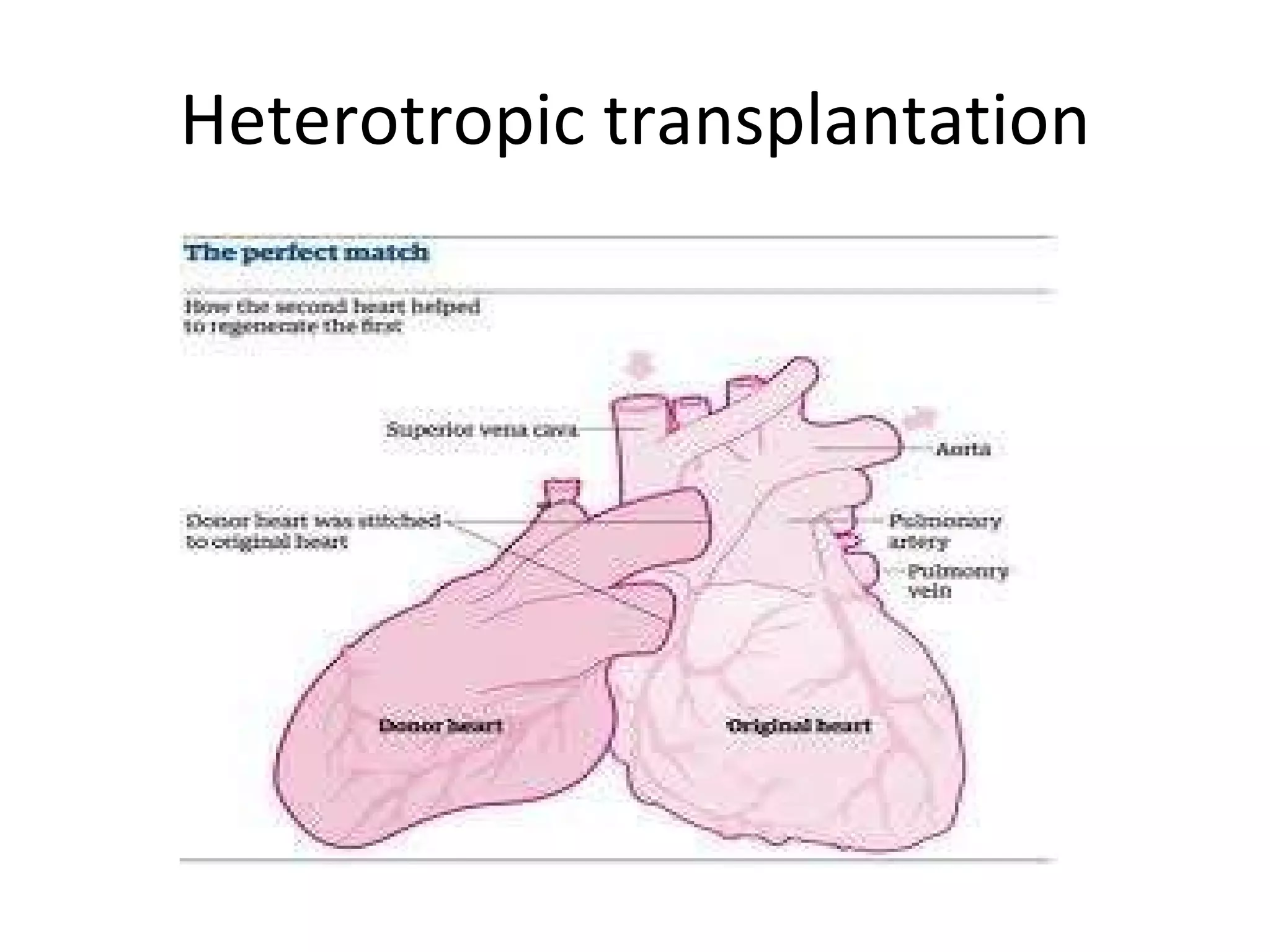 Heterotropic transplantation