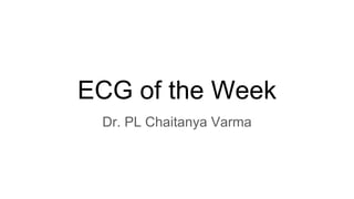 ECG of the Week
Dr. PL Chaitanya Varma
 