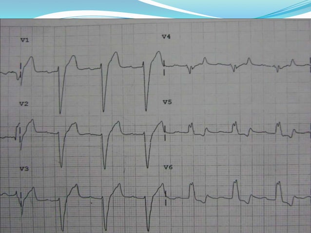 ECG: Trifascicular Block | PPTX