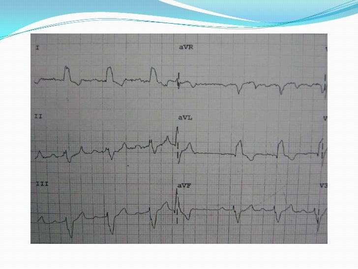 ECG Trifascicular Block