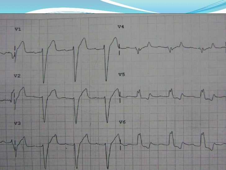 ECG Trifascicular Block