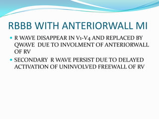 RBBB WITH ANTERIORWALL MIR WAVE DISAPPEAR IN V1-V4 AND REPLACED BY QWAVE DUE TO INVOLMENT OF ANTERIORWALL OF RVSECONDARY R WAVE PERSIST DUE TO DELAYED ACTIVATION OF UNINVOLVED FREEWALL OF RV