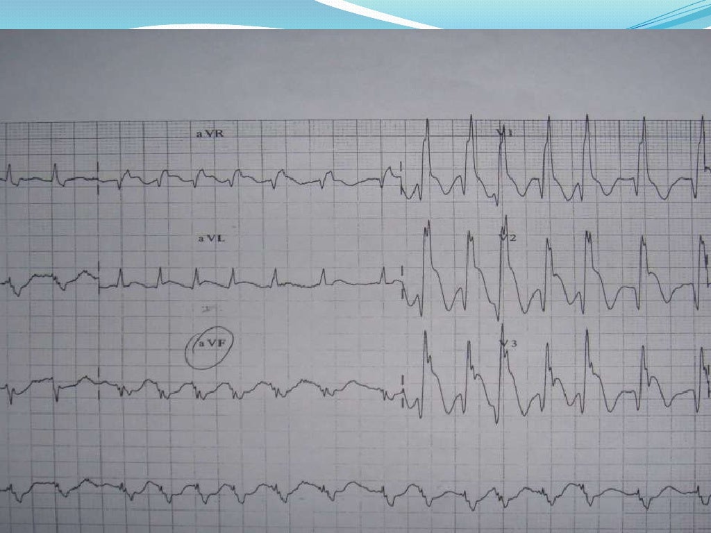 Bifascicular Block Ecg Review Learn The Heart vrogue.co
