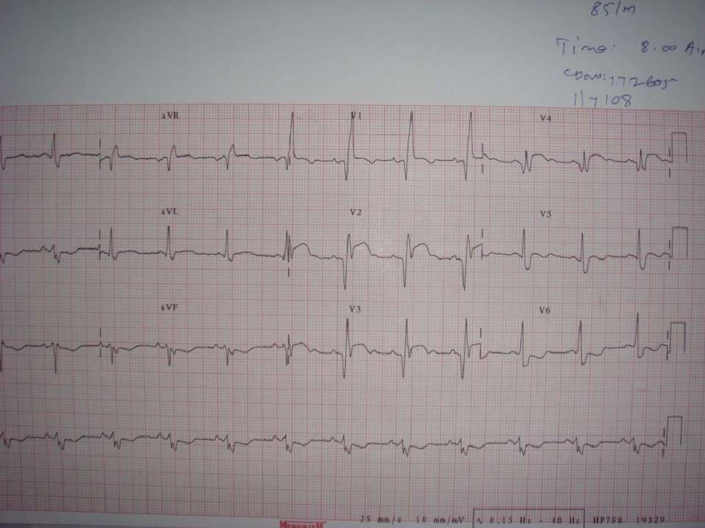 ECG Bifascicular Block