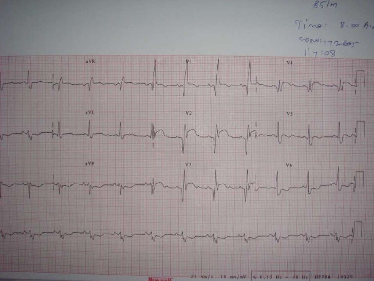 ECG Bifascicular Block