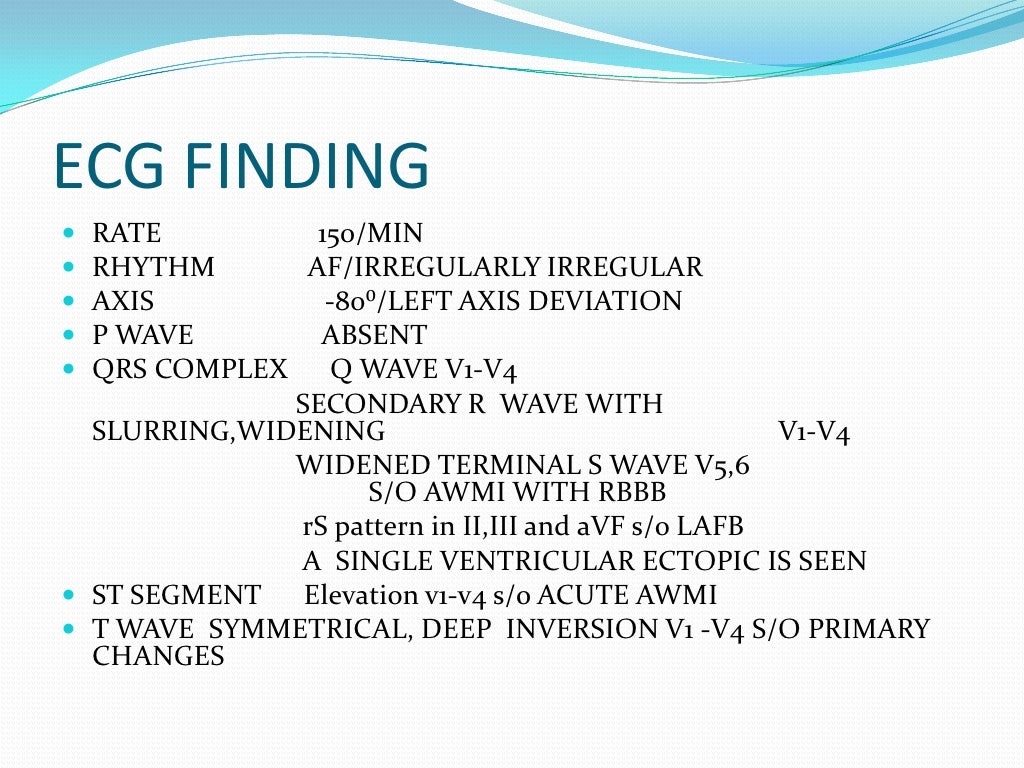 ECG Bifascicular Block