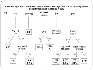 ECG: Atrial Bigeminy | PPT