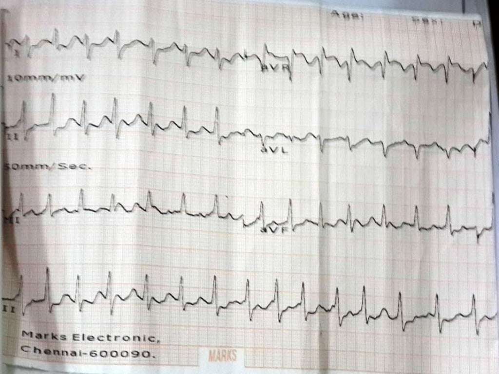 ECG Digitalis Effect / MAT / AF