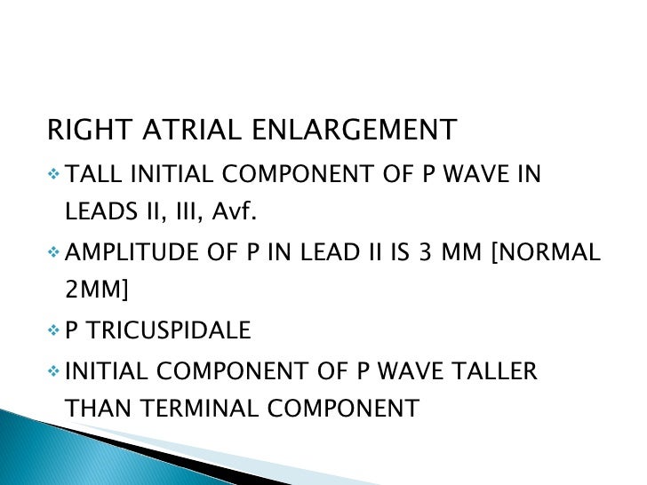 ECG Digitalis Effect