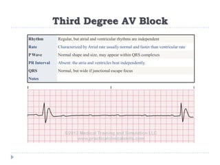 Third Degree AV Block
Rhythm Regular, but atrial and ventricular rhythms are independent
Rate Characterized by Atrial rate usually normal and faster than ventricular rate
P Wave Normal shape and size, may appear within QRS complexes
PR Interval Absent: the atria and ventricles beat independently.
QRS Normal, but wide if junctional escape focus
Notes
 