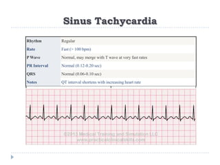 Sinus Tachycardia
Rhythm Regular
Rate Fast (> 100 bpm)
P Wave Normal, may merge with T wave at very fast rates
PR Interval Normal (0.12-0.20 sec)
QRS Normal (0.06-0.10 sec)
Notes QT interval shortens with increasing heart rate
 