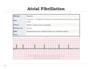 Atrial Fibrillation
Rhythm Irregular
Rate
Very fast (> 350 bpm) for Atrial, but ventricular rate may be slow, normal
or fast
P Wave Absent - erratic waves are present
PR Interval Absent
QRS Normal but may be widened if there are conduction delays
Notes
 