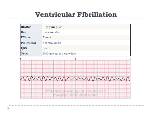 Ecg Or Ekg Sample Strips Ms Cardiovascular
