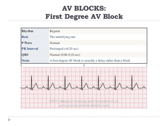 Ecg Or Ekg Sample Strips Ms Cardiovascular
