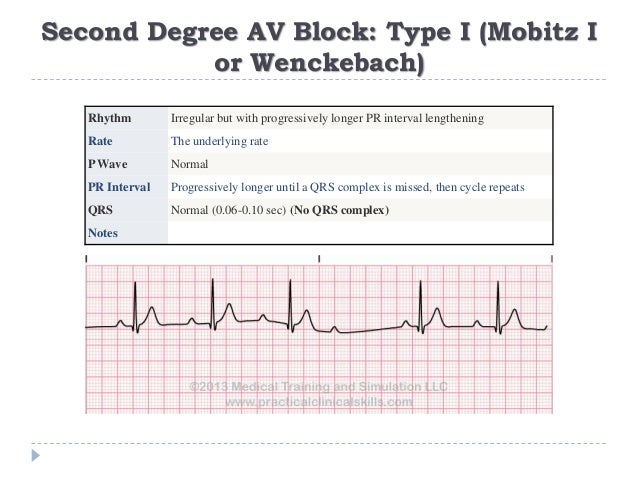 Ecg Or Ekg Sample Strips Ms Cardiovascular