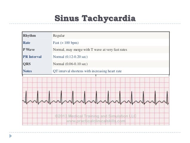 Ecg Or Ekg Sample Strips Ms Cardiovascular Ecg Or Ekg Sample Strips Ms Cardiovascular
