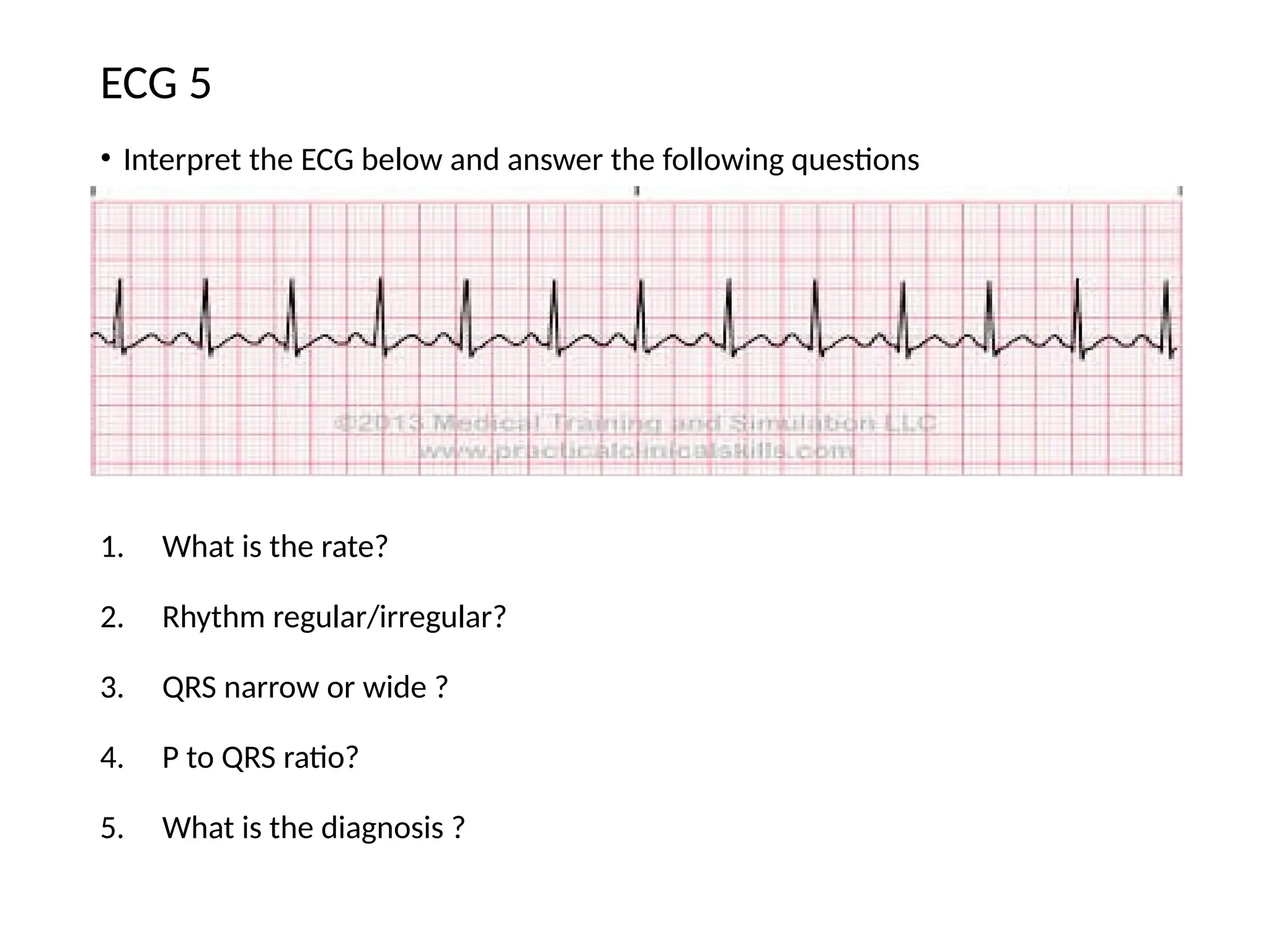 • Interpret the ECG below and answer the following questions
1. What is the rate?
2. Rhythm regular/irregular?
3. QRS narrow or wide ?
4. P to QRS ratio?
5. What is the diagnosis ?
ECG 5
 