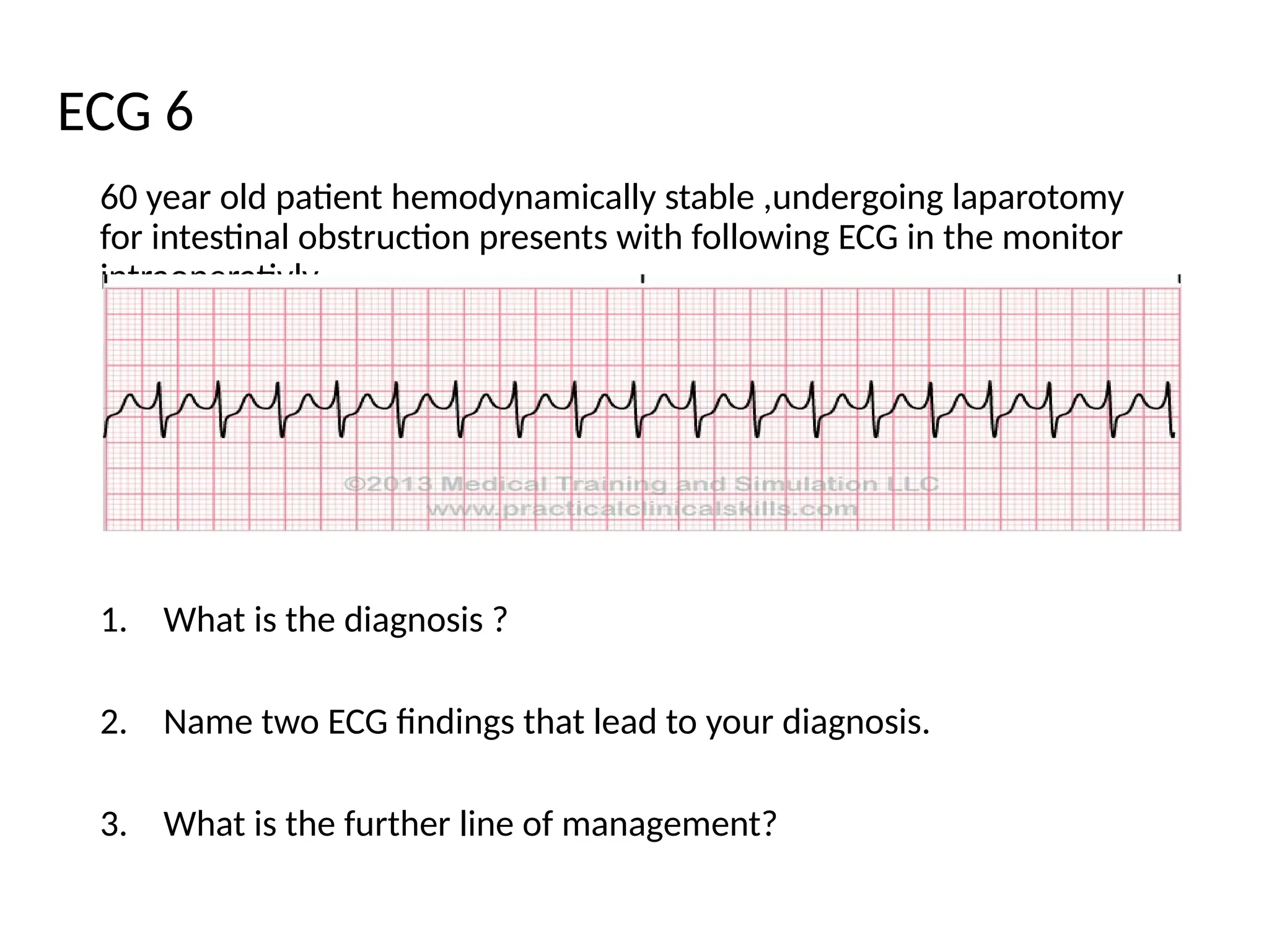 60 year old patient hemodynamically stable ,undergoing laparotomy
for intestinal obstruction presents with following ECG in the monitor
intraoperativly
1. What is the diagnosis ?
2. Name two ECG findings that lead to your diagnosis.
3. What is the further line of management?
ECG 6
 