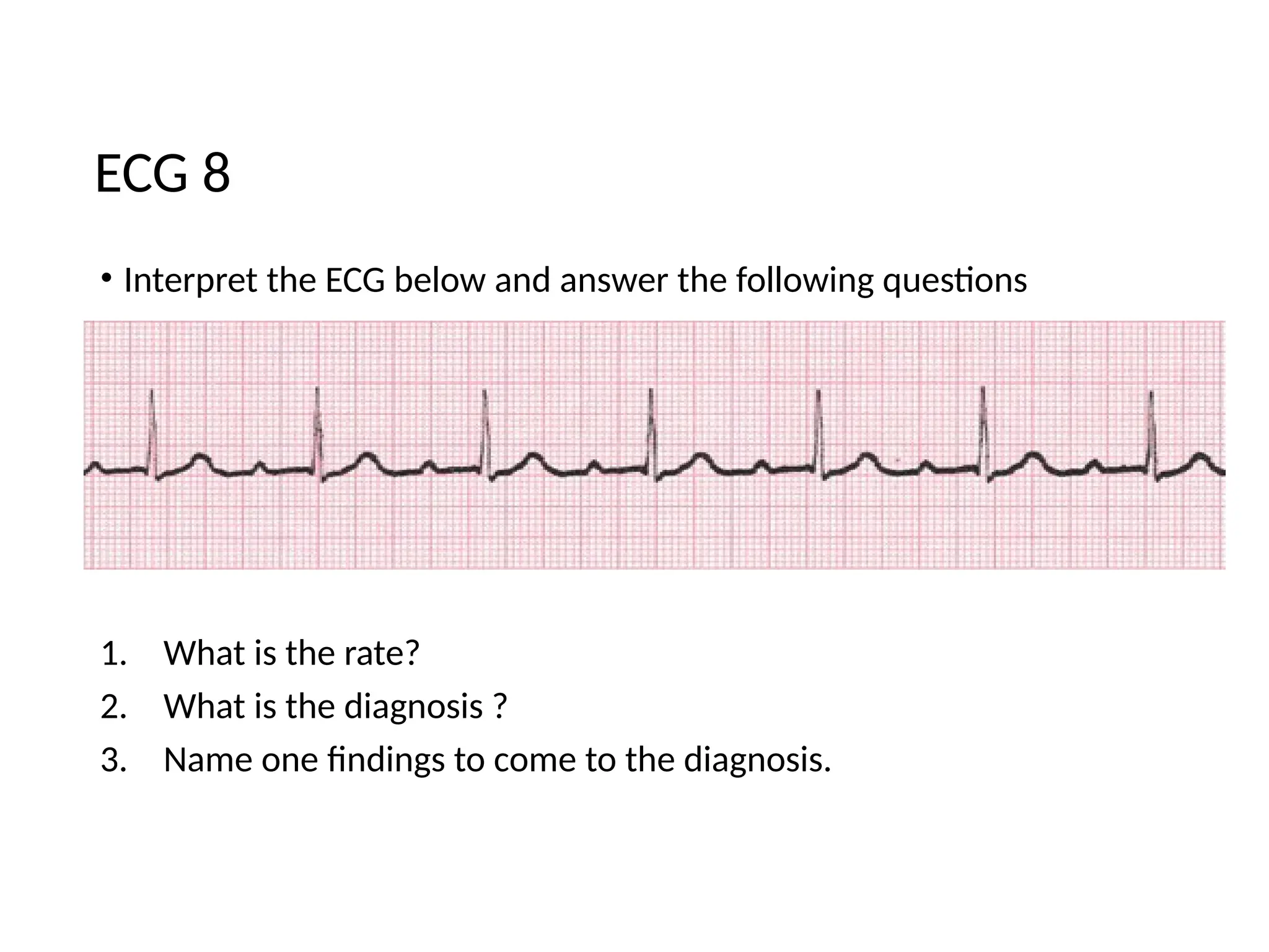 • Interpret the ECG below and answer the following questions
1. What is the rate?
2. What is the diagnosis ?
3. Name one findings to come to the diagnosis.
ECG 8
 