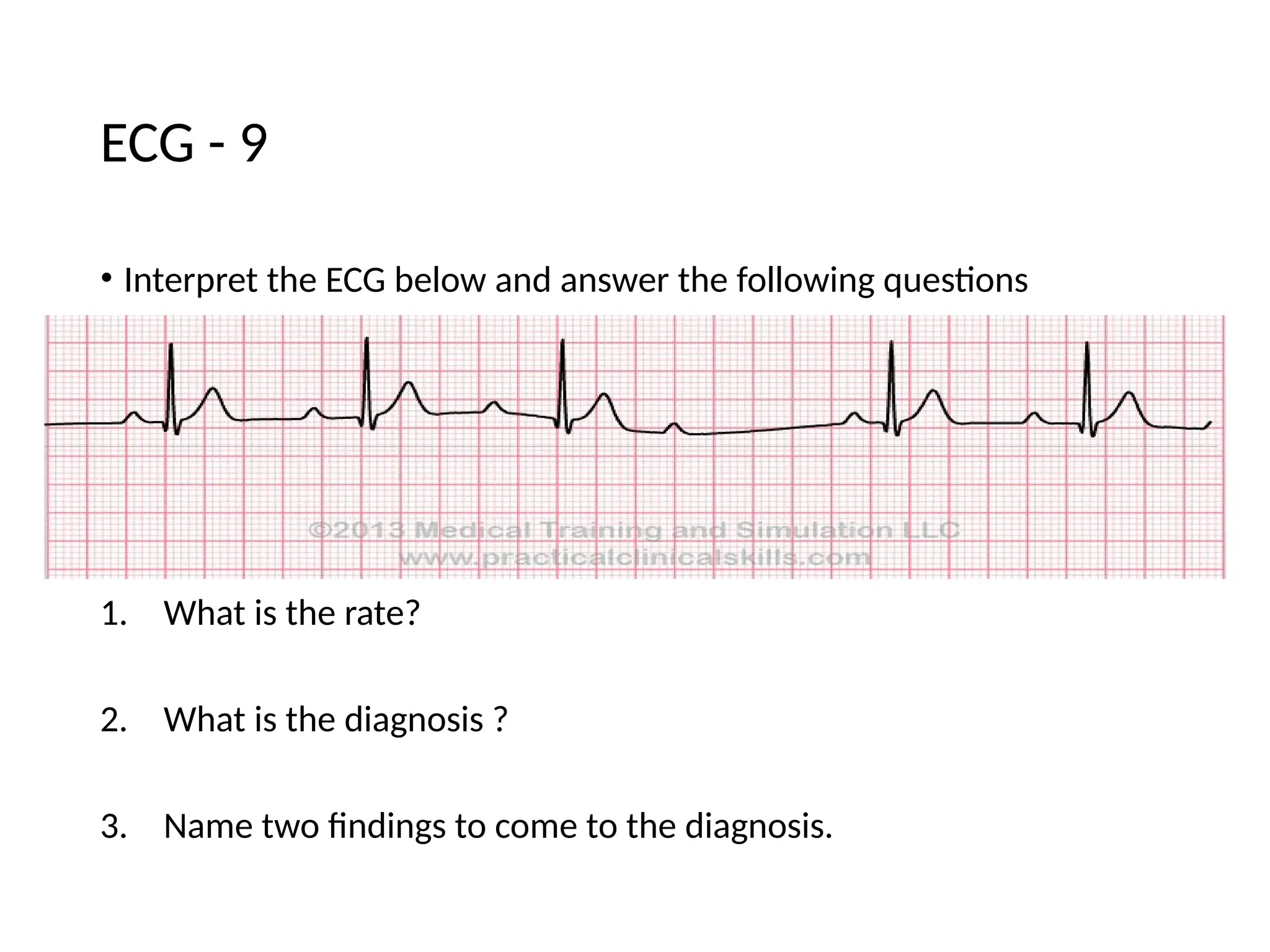 • Interpret the ECG below and answer the following questions
1. What is the rate?
2. What is the diagnosis ?
3. Name two findings to come to the diagnosis.
ECG - 9
 