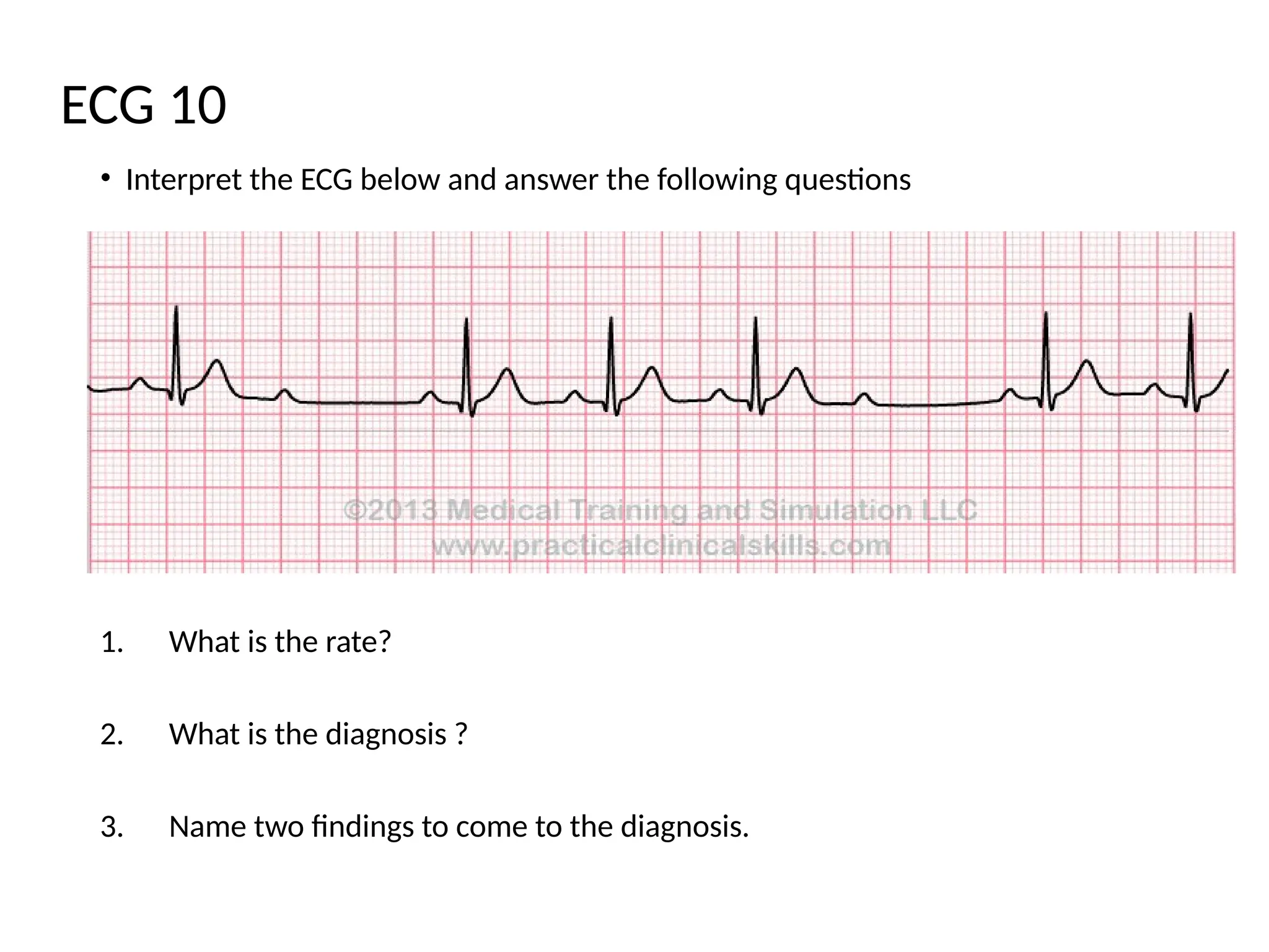 • Interpret the ECG below and answer the following questions
1. What is the rate?
2. What is the diagnosis ?
3. Name two findings to come to the diagnosis.
ECG 10
 