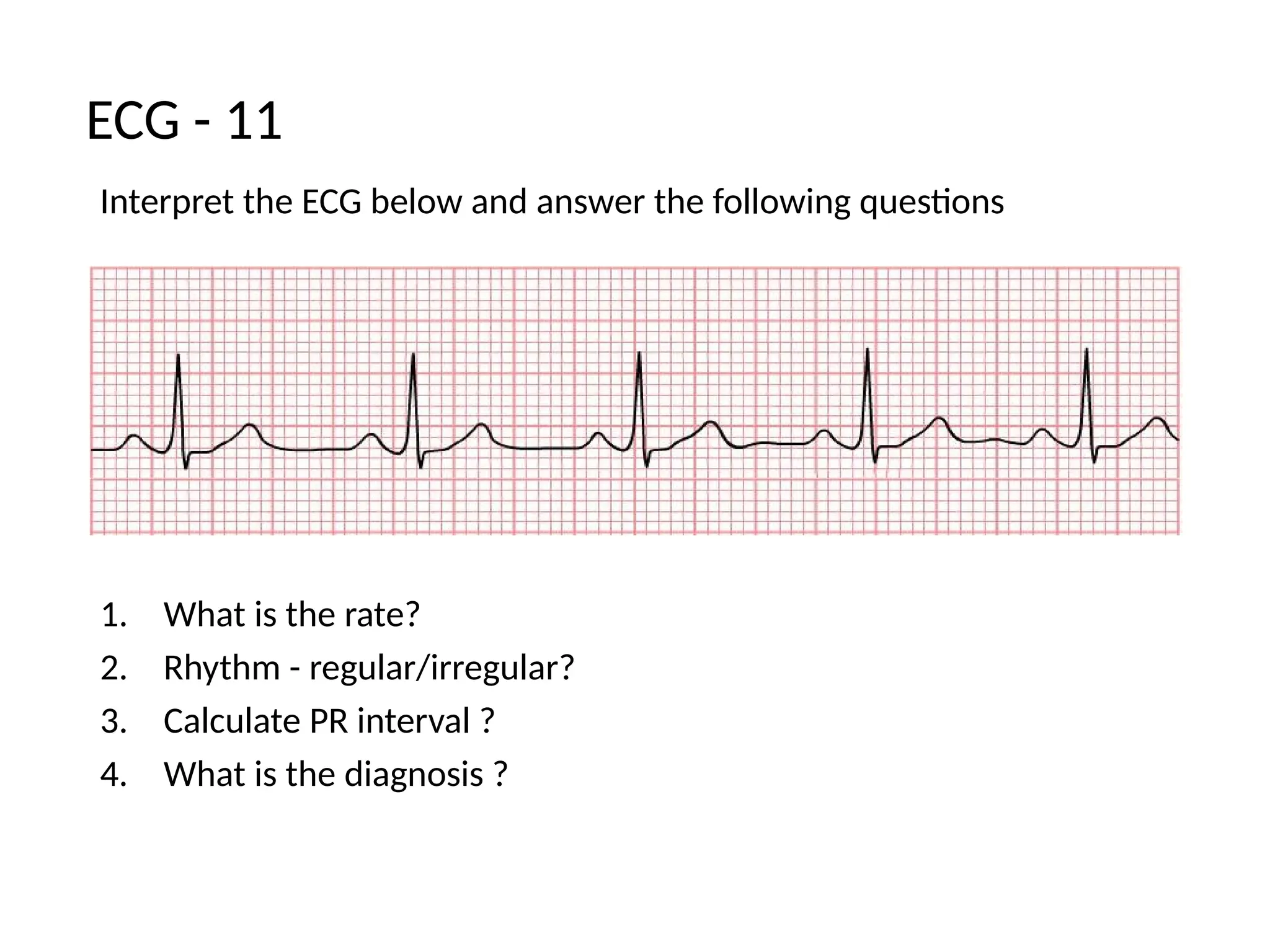 Interpret the ECG below and answer the following questions
1. What is the rate?
2. Rhythm - regular/irregular?
3. Calculate PR interval ?
4. What is the diagnosis ?
ECG - 11
 