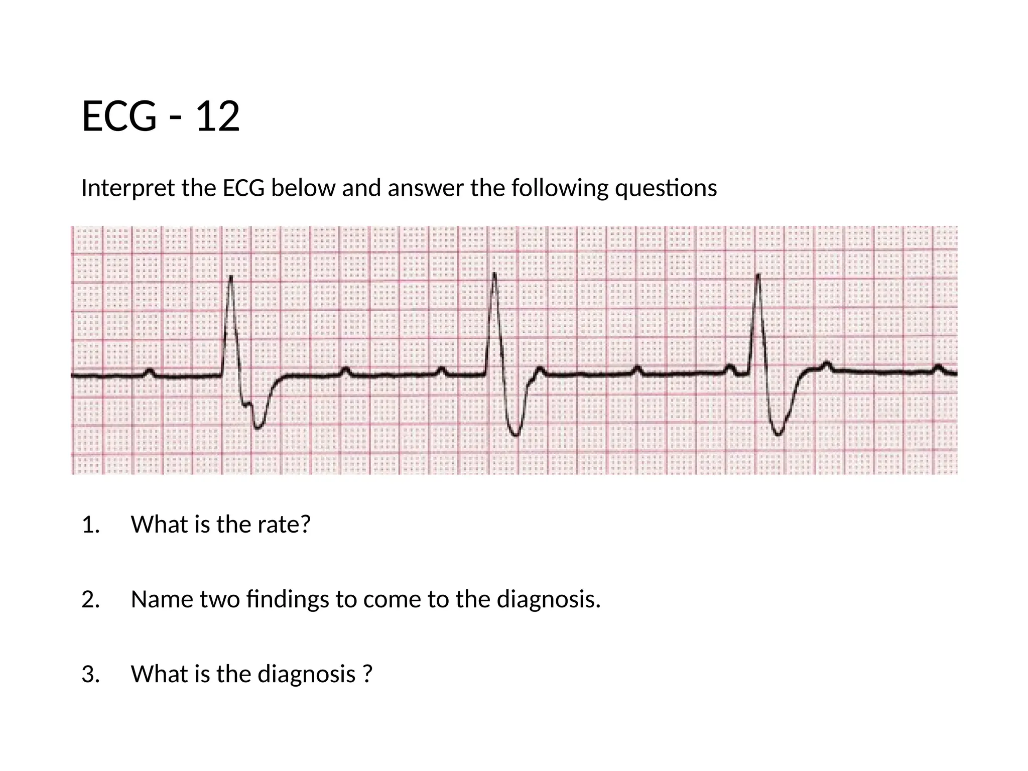 Interpret the ECG below and answer the following questions
1. What is the rate?
2. Name two findings to come to the diagnosis.
3. What is the diagnosis ?
ECG - 12
 