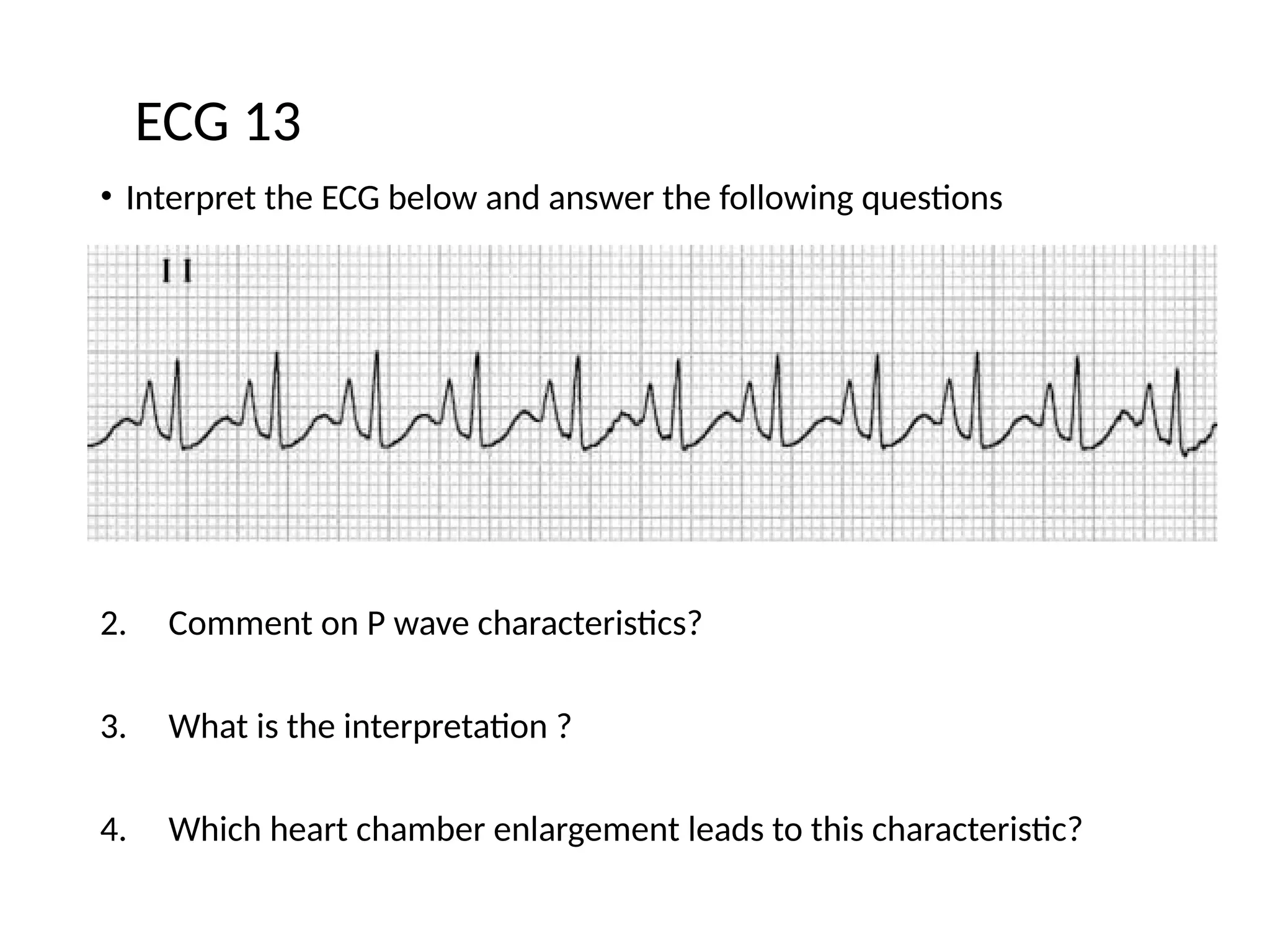 • Interpret the ECG below and answer the following questions
1. What is the rate? (1 mark)
2. Comment on P wave characteristics?
3. What is the interpretation ?
4. Which heart chamber enlargement leads to this characteristic?
ECG 13
 