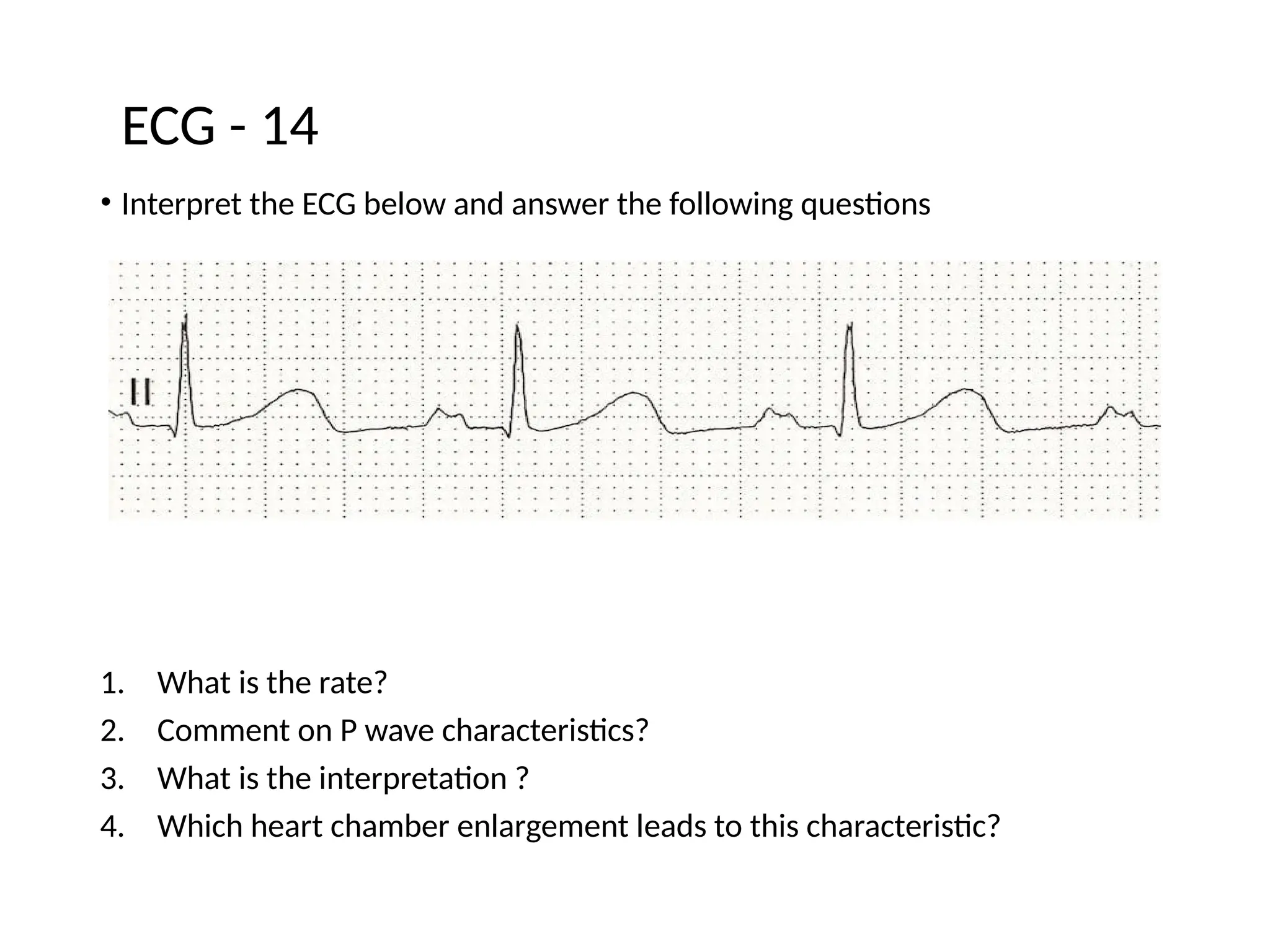 • Interpret the ECG below and answer the following questions
1. What is the rate?
2. Comment on P wave characteristics?
3. What is the interpretation ?
4. Which heart chamber enlargement leads to this characteristic?
ECG - 14
 