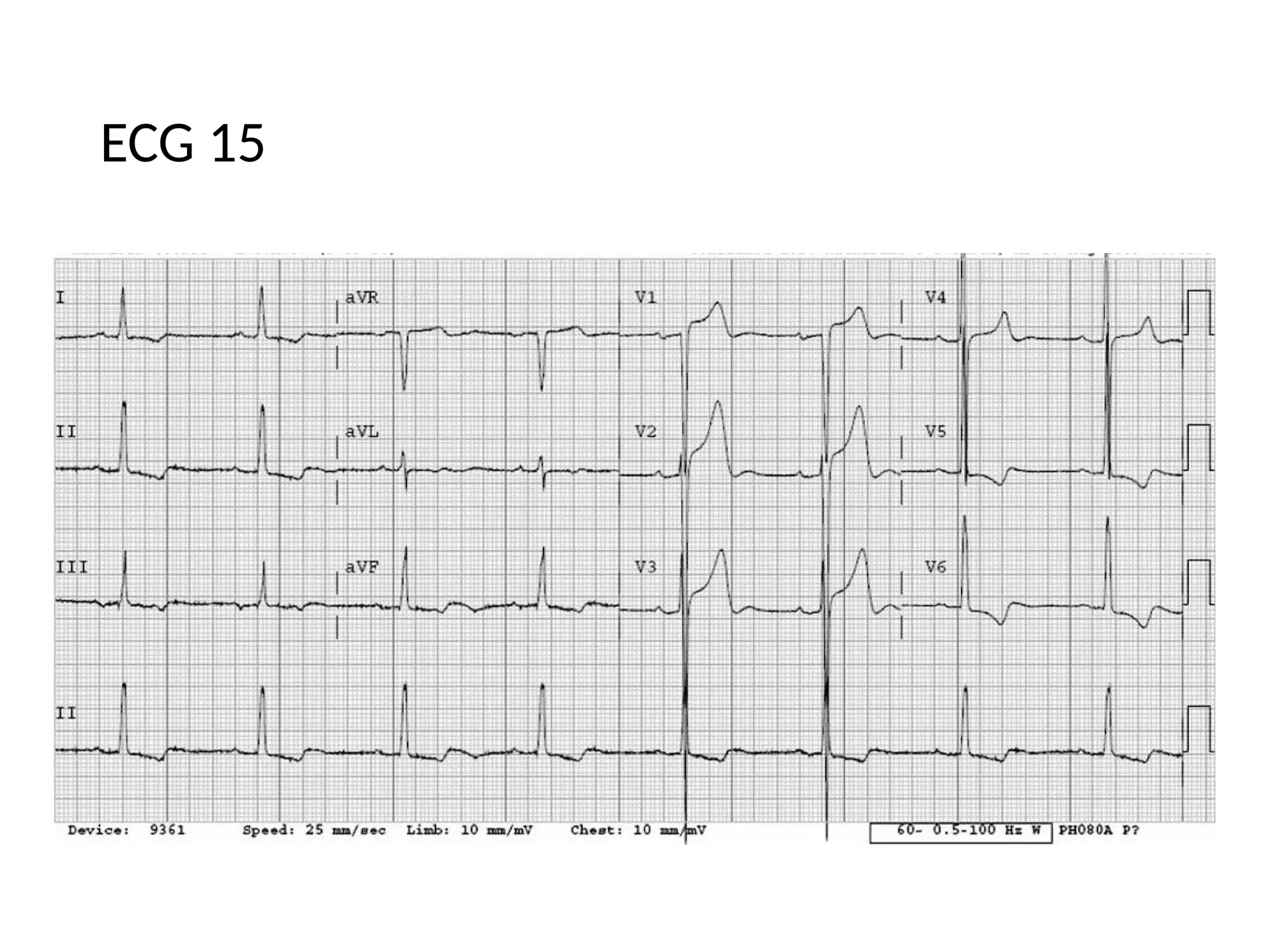ECG 15
 