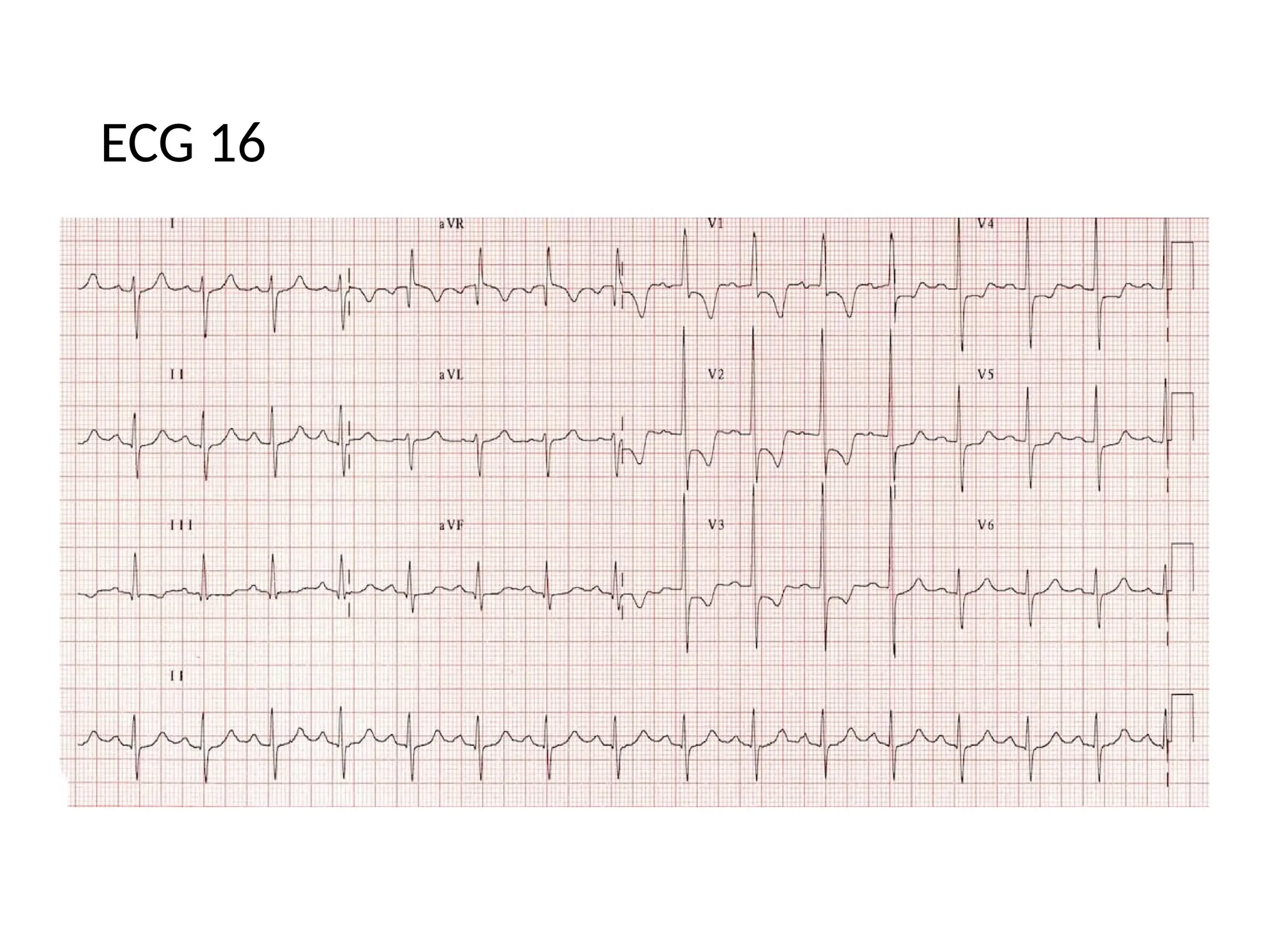 ECG 16
 