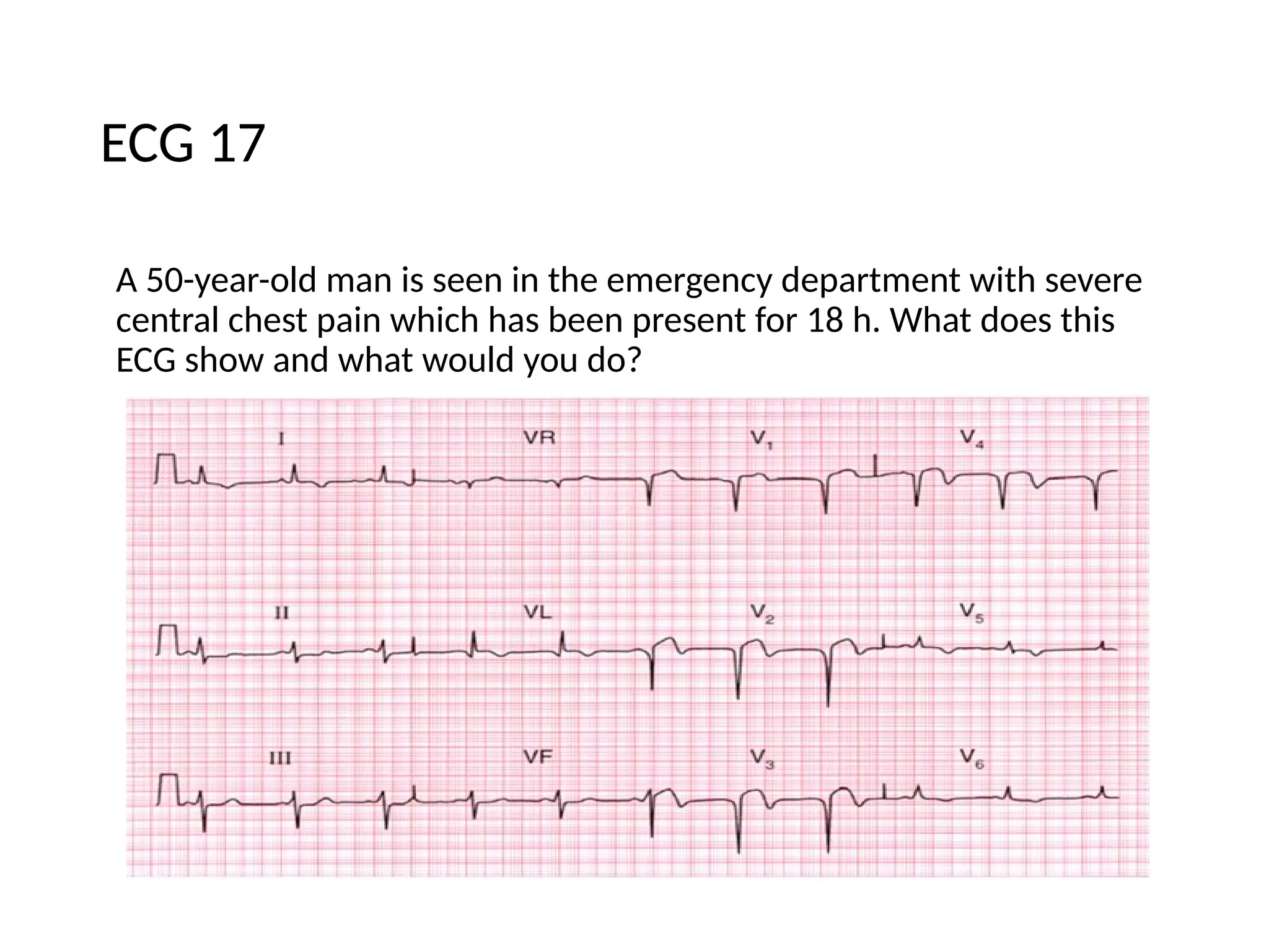 ECG 17
A 50-year-old man is seen in the emergency department with severe
central chest pain which has been present for 18 h. What does this
ECG show and what would you do?
 