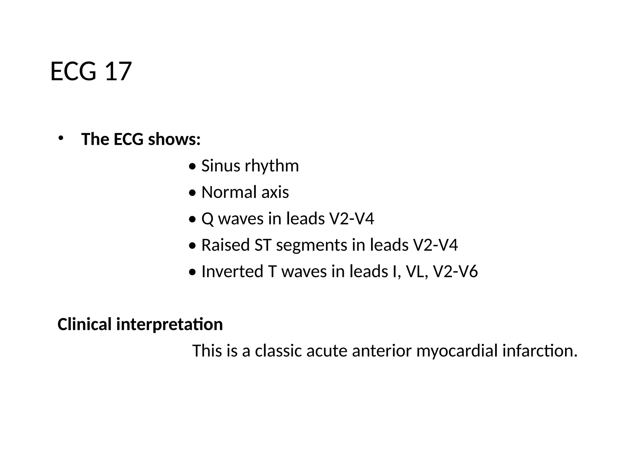 ECG 17
• The ECG shows:
• Sinus rhythm
• Normal axis
• Q waves in leads V2-V4
• Raised ST segments in leads V2-V4
• Inverted T waves in leads I, VL, V2-V6
Clinical interpretation
This is a classic acute anterior myocardial infarction.
 