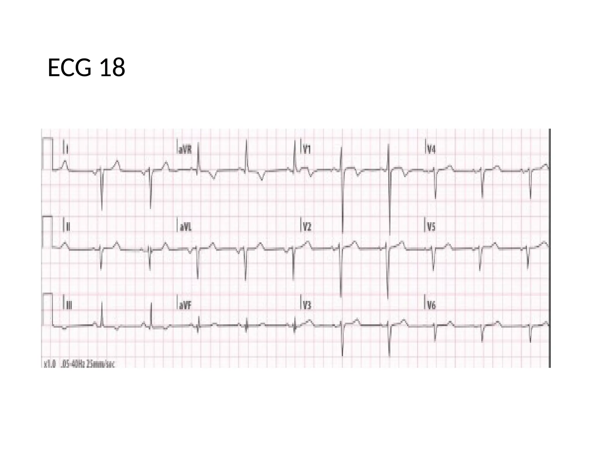 ECG 18
 