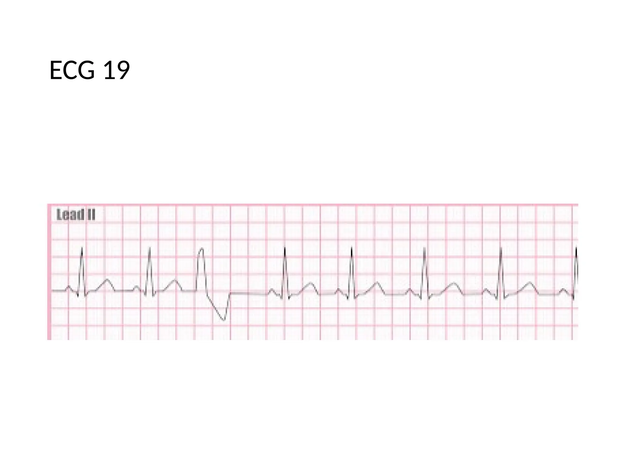 ECG 19
 