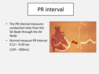 Pr Interval Ruler Ecg paramedics | PPTX
