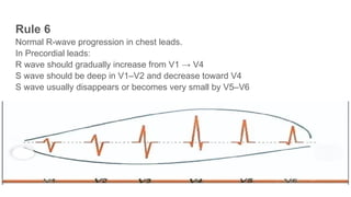 Normal R Wave Height Comprehensive Introduction to Electrocardiogram (ECG) Fundamentals and ...