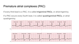 Comprehensive Guide to Electrocardiogram Rhythms and Arrhythmias | PDF