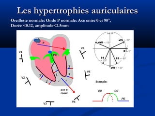 Les hypertrophies auriculairesLes hypertrophies auriculaires
Oreillette normale: Onde P normale: Axe entre 0 et 90°,
Durée <0.12, amplitude<2.5mm
 