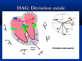HAG: Déviation axialeHAG: Déviation axiale
 